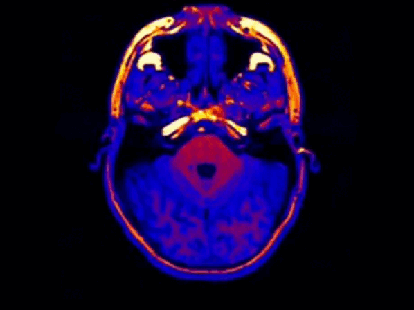 3D MRI del cerebro humano